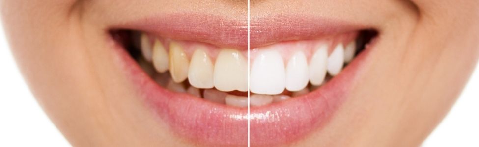 Smile with teeth whitening before and after